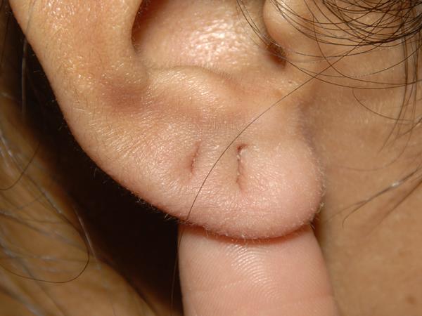 Repair of Torn Ear Lobe
