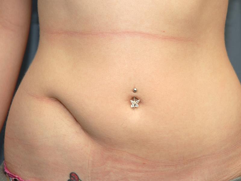 Scar Revision