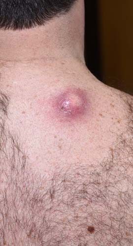 Infected Cysts