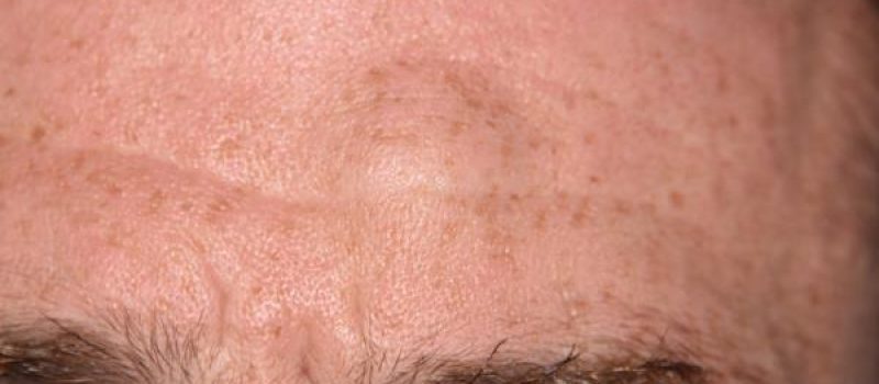 hurren-lipoma-forehead-1