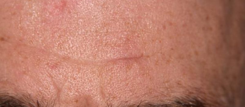 hurren-lipoma-forehead-2